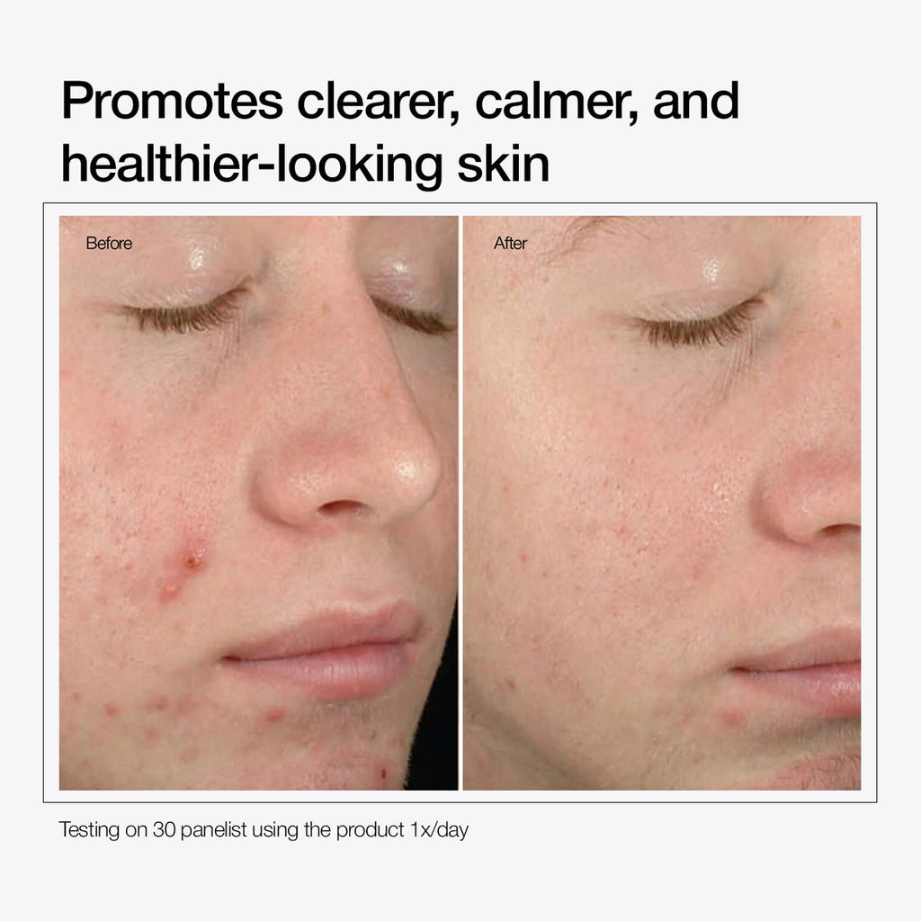 Salicylic Acid 2% Solution