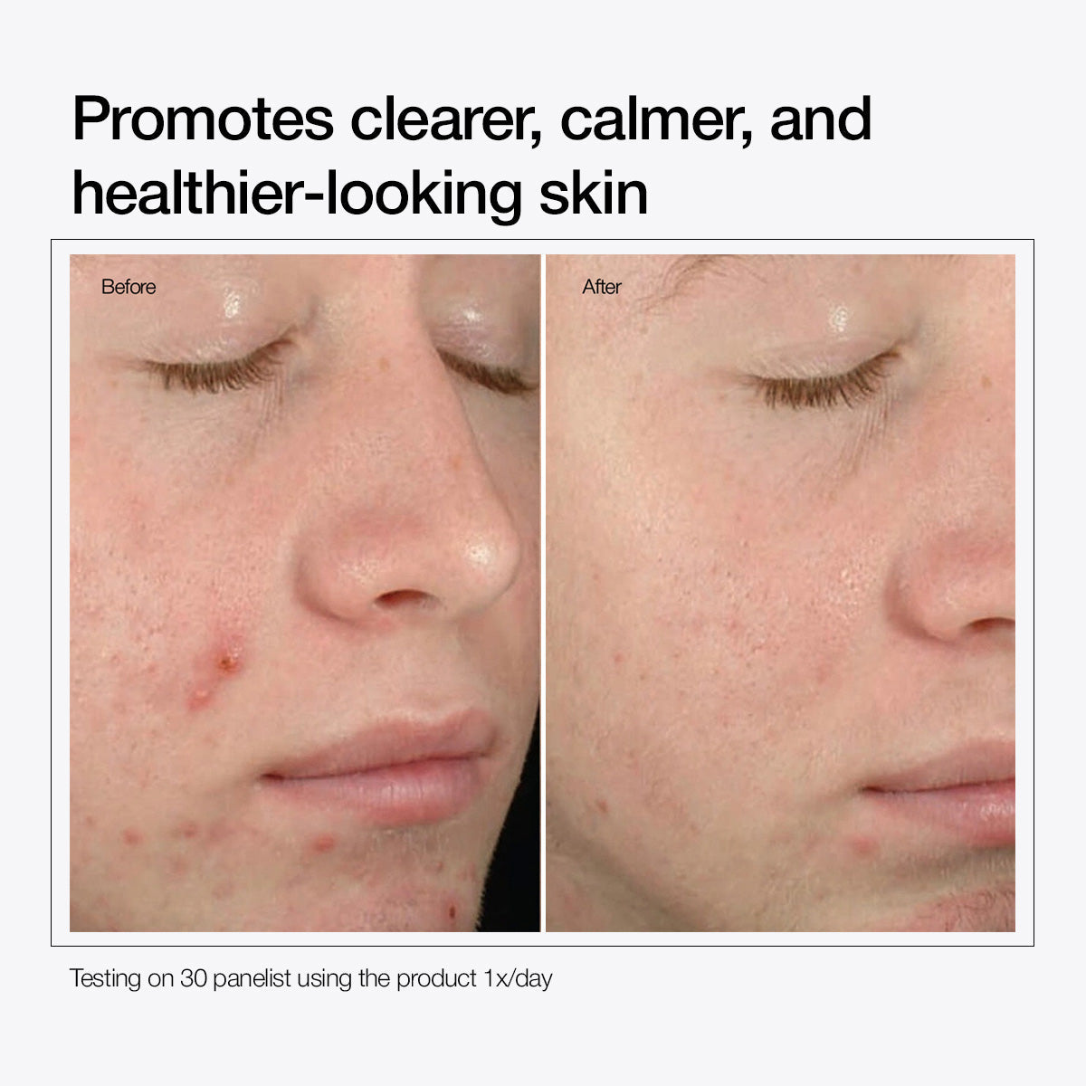 Salicylic Acid 2% Solution